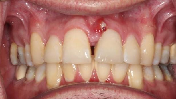 Dental abscess caused by improper dental laser use Perio Implant Advisory