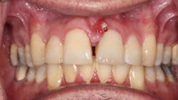 dental abscess dental abscess