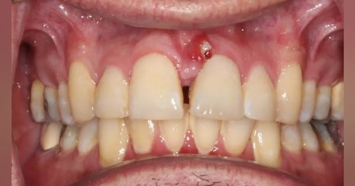 Dental Abscess Uptodate at Emery Espinosa blog