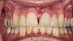 dental abscess