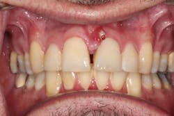 Figure 1: A 49-year-old male presented with pain at no. 9. A labial fistula was clinically present. Figure 1: A 49-year-old male presented with pain at no. 9. A labial fistula was clinically present.