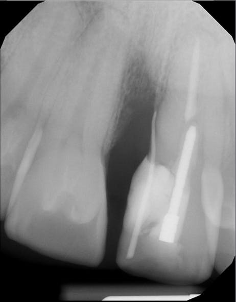 Figure 2: A periapical radiograph with gutta-percha tracing was taken to localize the infection.
