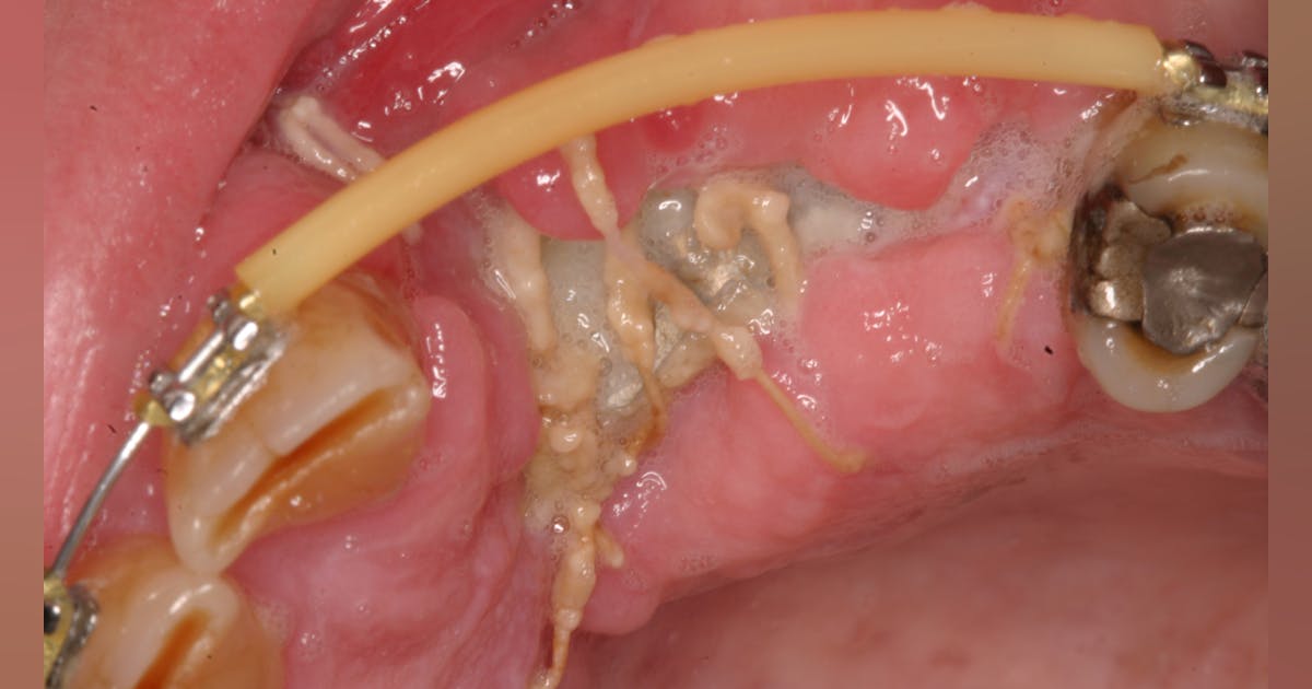 Do Dental Implants Require Stitches?