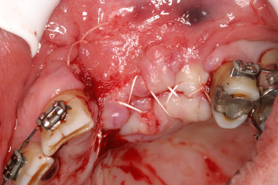 Figure 1: Flaps sutured under tension
