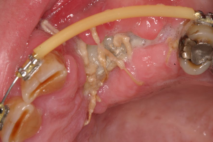 Figure 2: Flaps opened 10 days later with graft exposure