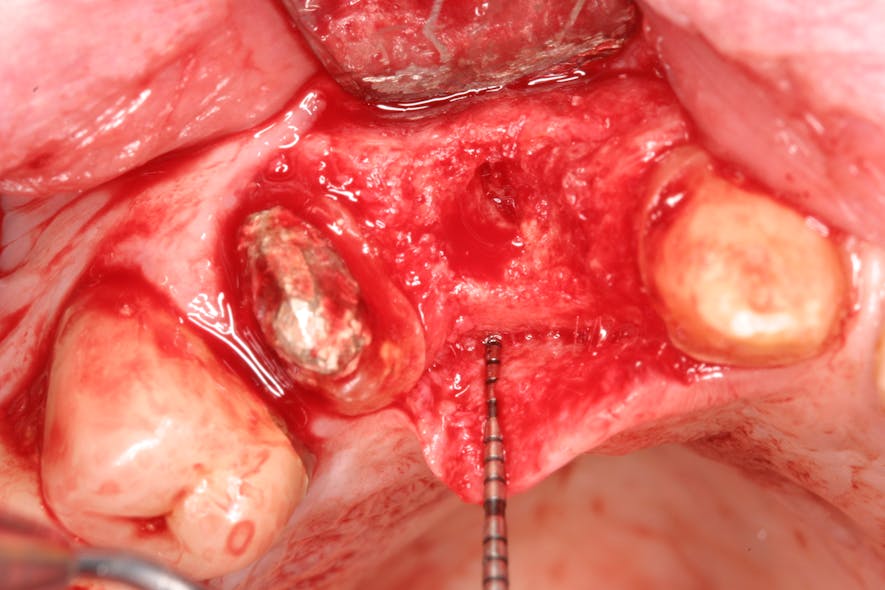 Figure 3: Extraction site exposed in need of graft