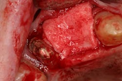 Figure 4: Tissue graft added to area