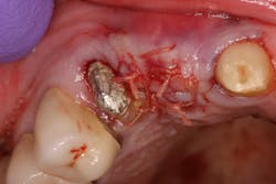 Figure 5: Primary closure without mattress sutures Figure 5: Primary closure without mattress sutures