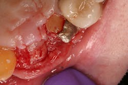 Figure 6: Three days later sutures failed and tissue became exposed Figure 6: Three days later sutures failed and tissue became exposed