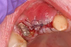 Figure 7: Tissue is resutured and patient is put on StellaLife mouthrinse Figure 7: Tissue is resutured and patient is put on StellaLife mouthrinse