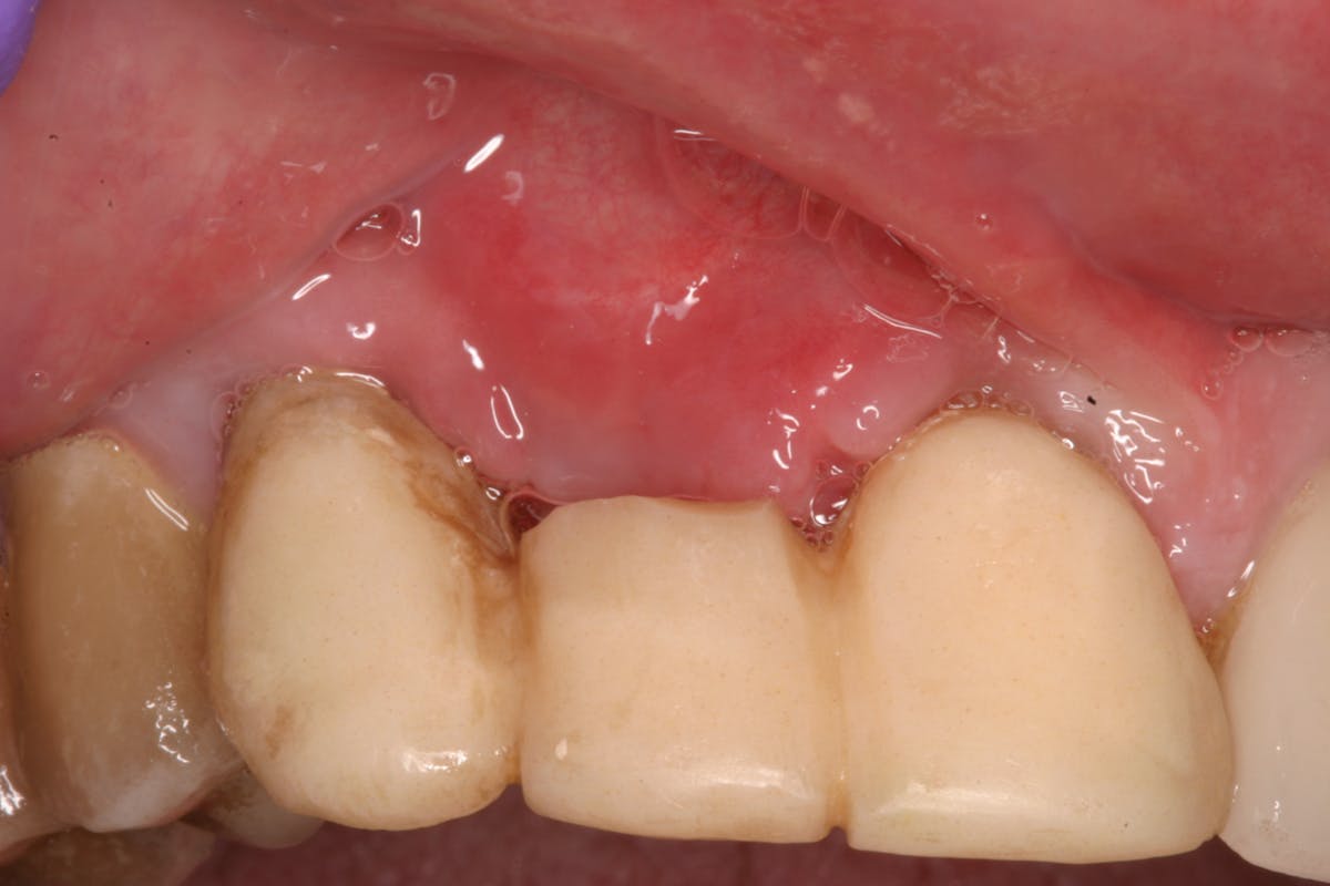 Why do incision lines open, and what can I do about it? | Perio Implant ...