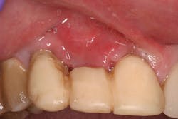 Figure 8: Buccal shot of area 10 days later Figure 8: Buccal shot of area 10 days later