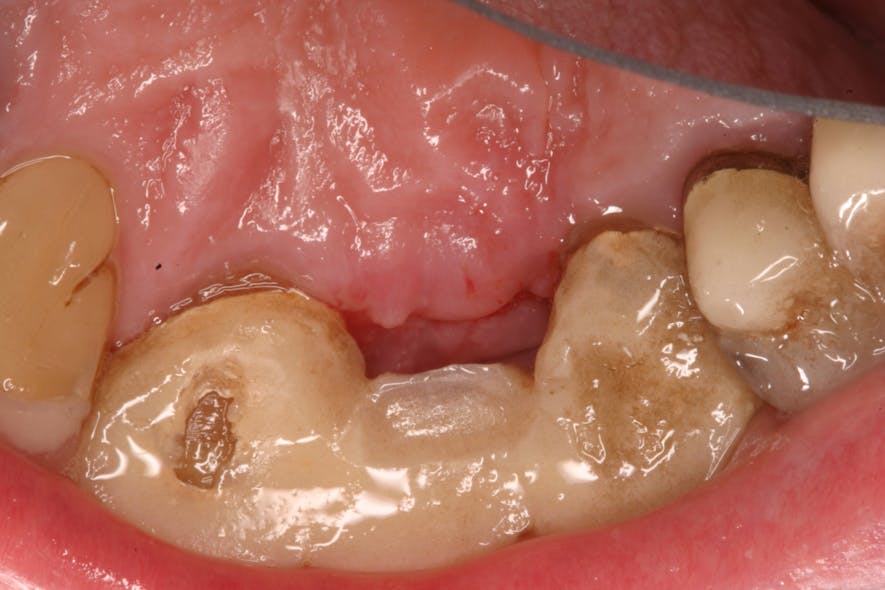 Figure 9: Palatal shot of area 10 days later