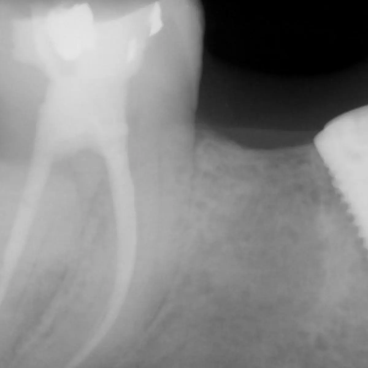 Ferrule: Why is it important, and how much do we need? | Perio Implant ...