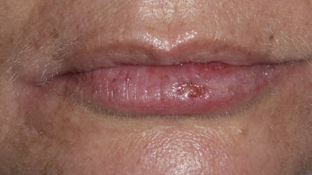 Laser treatment of cold sores Perio Implant Advisory