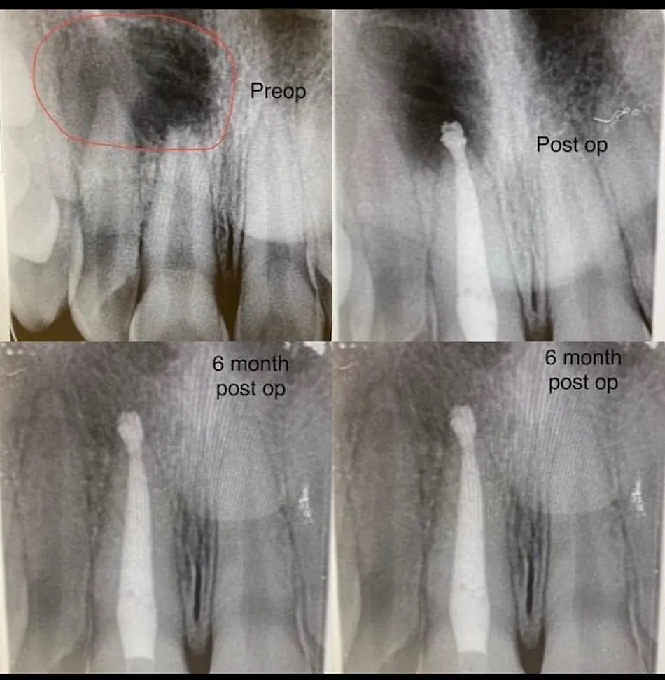 Image showcasing Healing after root canal therapy: When should you get a crown placed ...