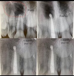 Figure 1: Large radiographic lesion treated with apicoectomy followed by a healing phase of six months. This tooth was not restored with a crown and allowed to heal because fracture potential was low and preoperative infection was high.
