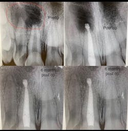 Figure 1: Large radiographic lesion treated with apicoectomy followed by a healing phase of six months. This tooth was not restored with a crown and allowed to heal because fracture potential was low and preoperative infection was high. Figure 1: Large radiographic lesion treated with apicoectomy followed by a healing phase of six months. This tooth was not restored with a crown and allowed to heal because fracture potential was low and preoperative infection was high.
