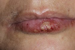 Figure 1: Herpes labialis lesion upon initial presentation Figure 1: Herpes labialis lesion upon initial presentation