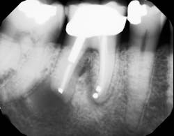 Figure 2: A large lesion around tooth nos. 30 and 31. Figure 2: A large lesion around tooth nos. 30 and 31.