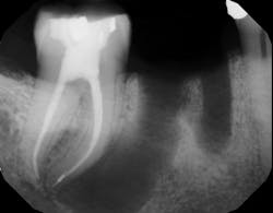 Figure 3: Tooth no. 30 was extracted, and tooth no. 31 was treated with nonsurgical root canal therapy. Figure 3: Tooth no. 30 was extracted, and tooth no. 31 was treated with nonsurgical root canal therapy.