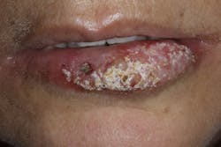 Figure 3: Clinical appearance after LLLT with Solea laser Figure 3: Clinical appearance after LLLT with Solea laser