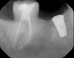 Figure 4: Eight months of healing shows good bone fill around no. 31. Figure 4: Eight months of healing shows good bone fill around no. 31.