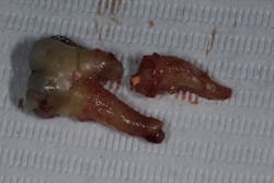 Figure 5: At 12 months without proper coronal coverage, tooth no. 31 fractures. Figure 5: At 12 months without proper coronal coverage, tooth no. 31 fractures.