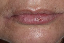 Figure 5: Follow-up four days after procedure Figure 5: Follow-up four days after procedure