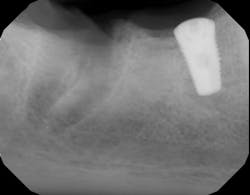 Figure 6: Tooth no. 31 needed to be extracted. Figure 6: Tooth no. 31 needed to be extracted.