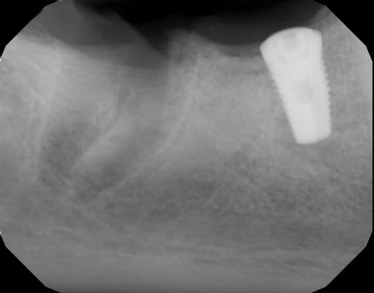 Figure 6: Tooth no. 31 needed to be extracted.