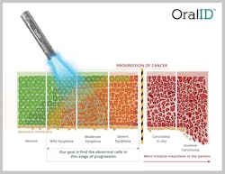 Figure 1: Stages of cancer progression Figure 1: Stages of cancer progression