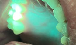 Figure 2a: OralID showing mild epithelial dysplasia Figure 2a: OralID showing mild epithelial dysplasia