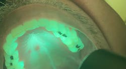 Figure 2b: OralID showing moderate epithelial dysplasia Figure 2b: OralID showing moderate epithelial dysplasia