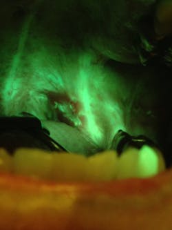 Figure 2d: OralID showing carcinoma in situ Figure 2d: OralID showing carcinoma in situ