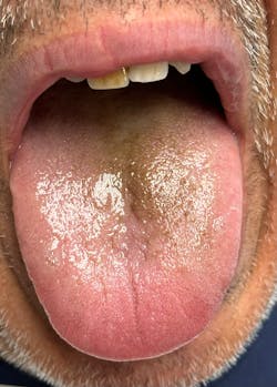 Figure 1: Patient with poor oral hygiene has a black hairy tongue after taking an antibiotic for 10 days