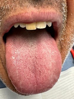 Figure 3: After two weeks of using StellaLife rinse, gel, and probiotic lozenge Figure 3: After two weeks of using StellaLife rinse, gel, and probiotic lozenge