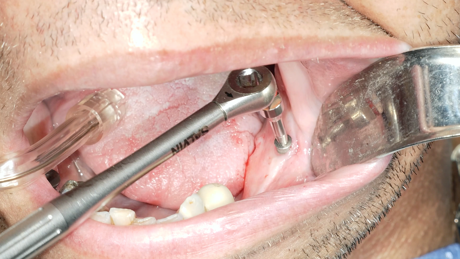 Successful removal of a damaged dental implant