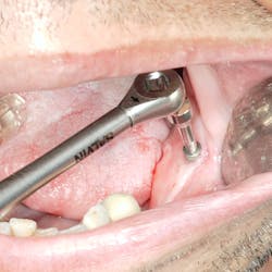Successful removal of a damaged dental implant