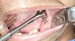 Successful removal of a damaged dental implant