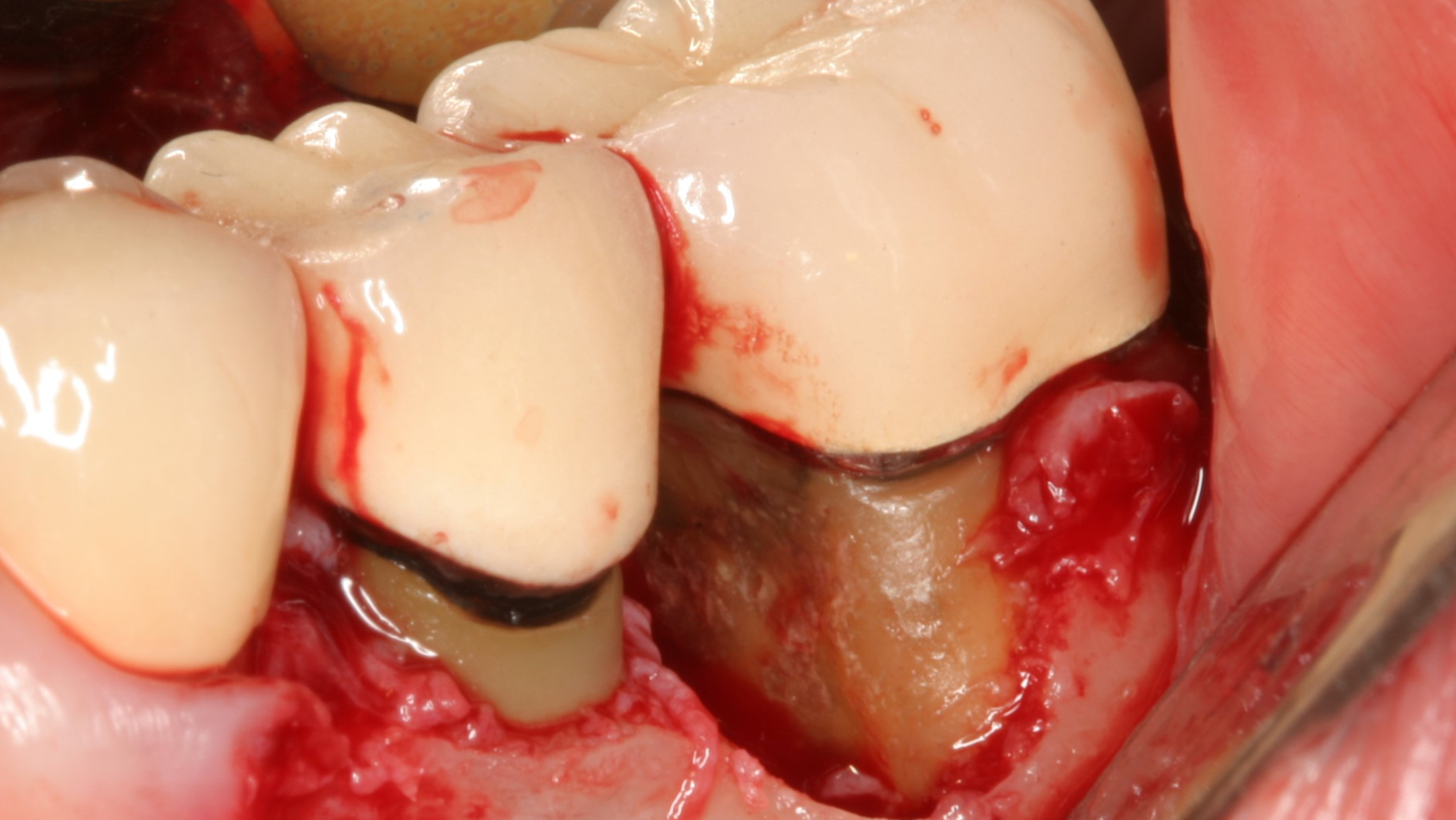 Primary Fractured Calculus Dental Implant Failure 2 65411d6656fec