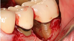 Primary Fractured Calculus Dental Implant Failure