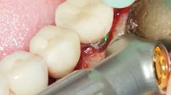Decontamination (with a dental laser) and graft case of moderate peri-implantitis