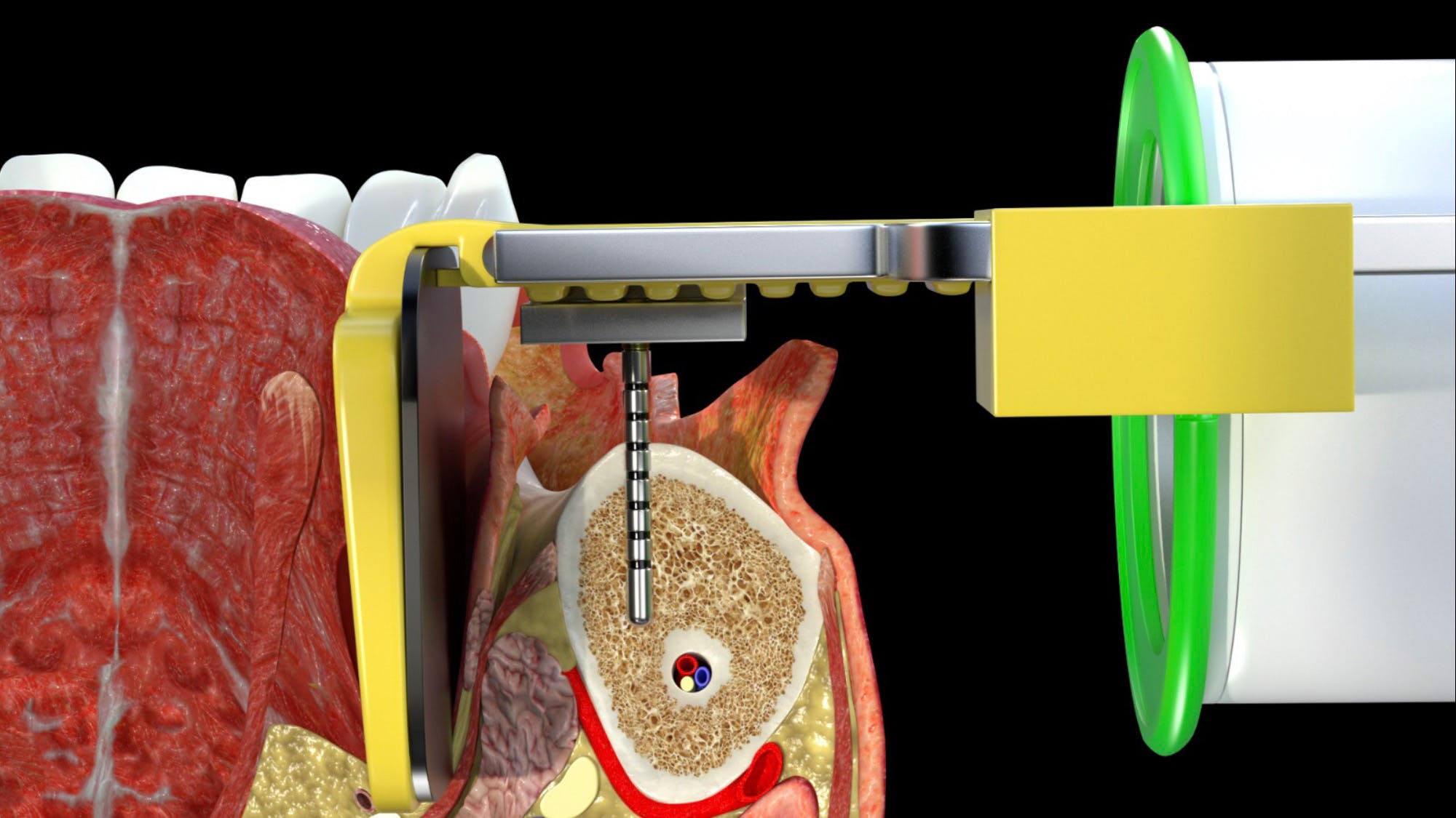 primary-solution-implant-malposition