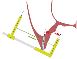 Figure 1: X-ray alignment distortion Figure 1: X-ray alignment distortion