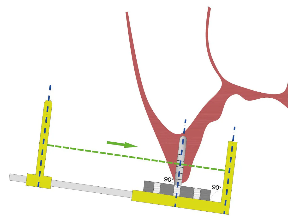 X Ray Alignment Implant malposition: A new, easy-to-use radiographic aid for prevention ...