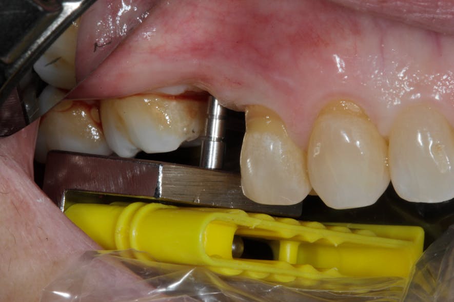 Figure 6: Using the Sniper X-Ray System to accurately place a dental implant