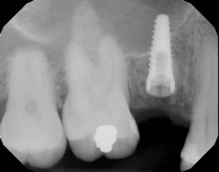 Figure 6a: Use of the Sniper X-Ray System assures accurate implant placement