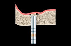 Figure 2: Traditional osteotome technique sinus lift. Note that the sinus bone floor is manually upfractured by tapping with a mallet. Figure 2: Traditional osteotome technique sinus lift. Note that the sinus bone floor is manually upfractured by tapping with a mallet.