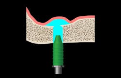 Figure 3: Hydraulic sinus lift technique. Only saline is used to gently lift the sinus membrane. The bone graft will subsequently be inserted into the sinus using a noninvasive funnel. Figure 3: Hydraulic sinus lift technique. Only saline is used to gently lift the sinus membrane. The bone graft will subsequently be inserted into the sinus using a noninvasive funnel.